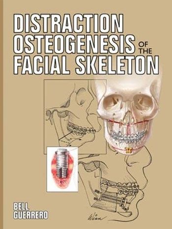 Distraction Osteogenesis of The Facial Skeleton