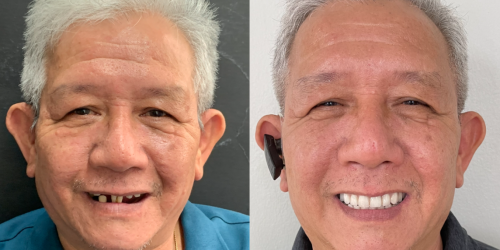 images/services/perinasal-pterygoid-zygomatic-implants/dr-cesar-guerrero_perinasal-pterygoid-zygomatic-implants_7.png