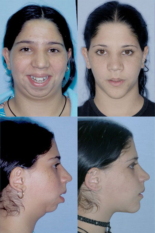 Before and after of a patient's distraction osteogenesis - Dr. Cesar Guerrero - Houston, TX