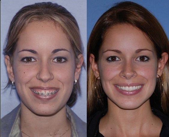 Before and after of a patient's distraction osteogenesis - Dr. Cesar Guerrero - Houston, TX