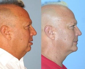 Before and after of a patient's maxillo-mandibular widening - Dr. Cesar Guerrero - Houston, TX