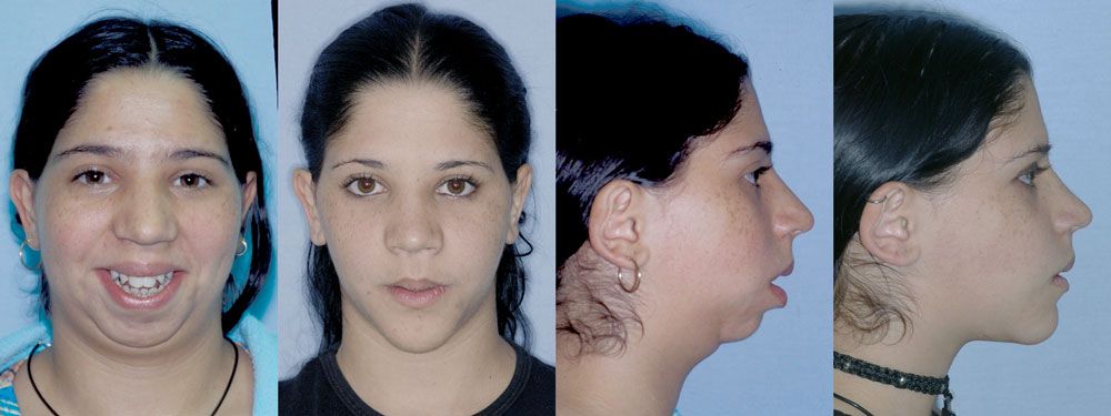 corrective jaw surgery before and after - front and side profile - Dr. Cesar Guerrero - Houston, TX