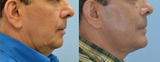 Before and after of a patient's maxillo-mandibular widening - Dr. Cesar Guerrero - Houston, TX