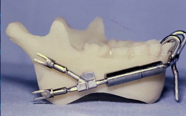 Distraction Osteogenesis device