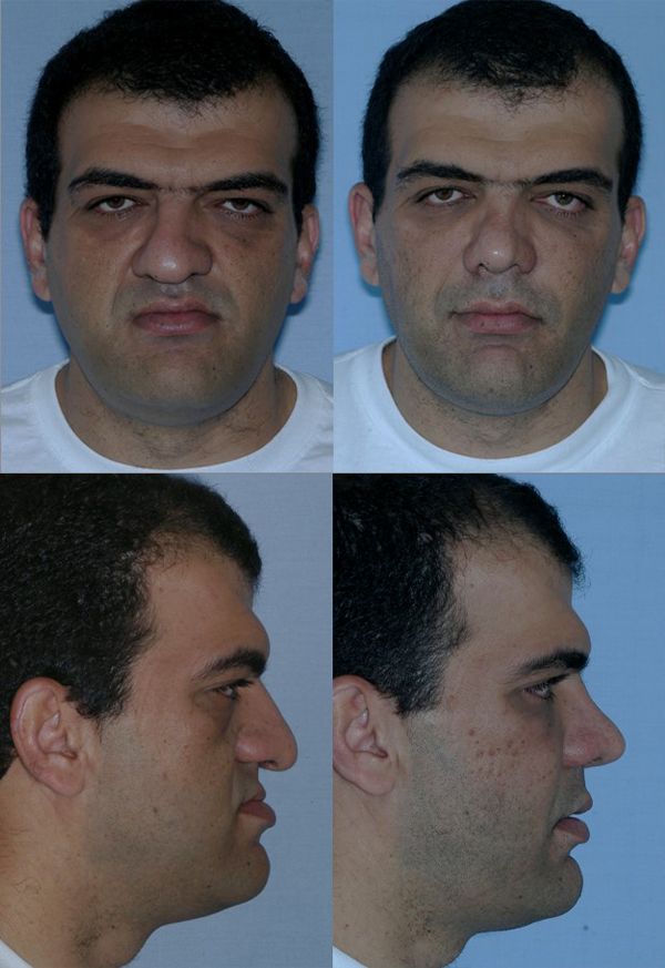 Before and after of a patient's distraction osteogenesis - Dr. Cesar Guerrero - Houston, TX