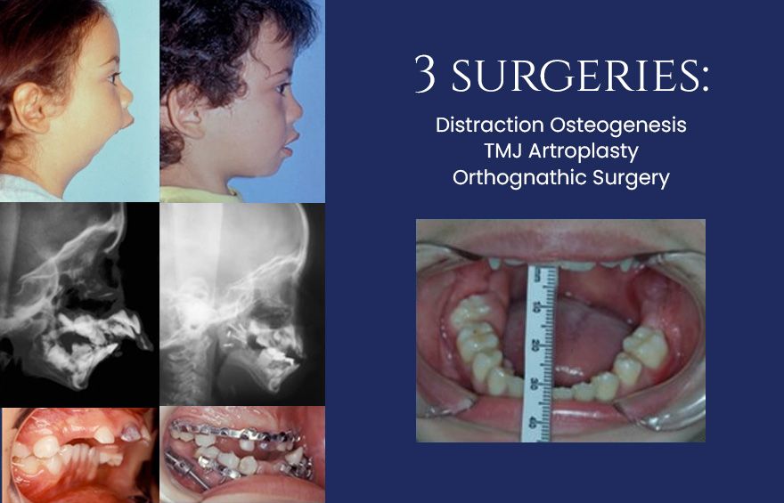 three surgeries performed on patient: distraction osteogenesis, TMJ artroplasty, and orthognatic surgery - Dr. Cesar Guerrero - Houston, TX