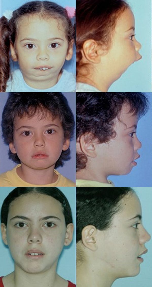 Before and after of a patient's distraction osteogenesis - Dr. Cesar Guerrero - Houston, TX