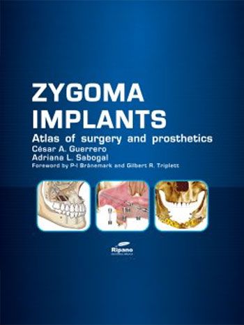 Zygoma Implants: Atlas of Surgery and Prosthetics